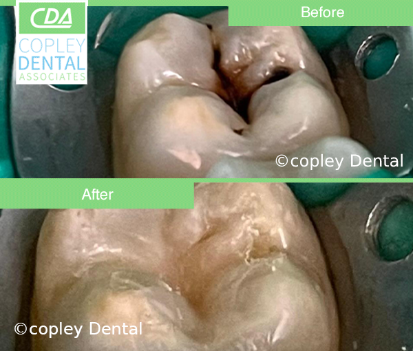CASE 10: Cosmetic Dentistry – White Dental Filling