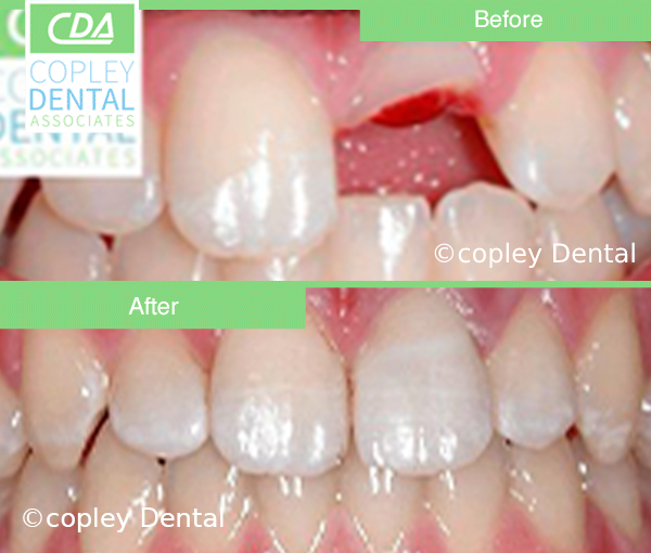 CASE 40: Emergency Treatment – Fractured Tooth
