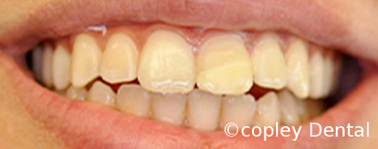 CASE 42: Emergency Dentist – Broken Tooth - After