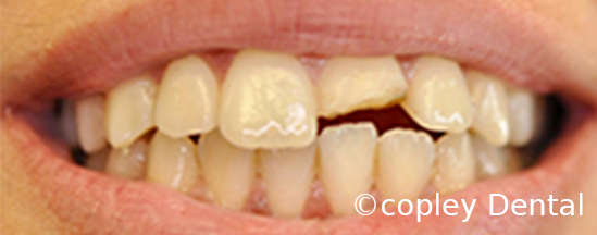 CASE 42: Emergency Dentist – Broken Tooth - Before