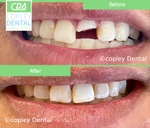 CASE 47: Fractured Tooth