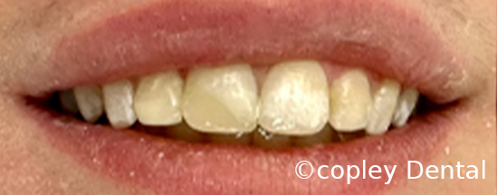 CASE 56: Fractured Tooth - After