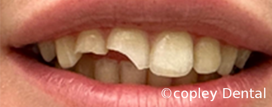 CASE 56: Fractured Tooth - Before