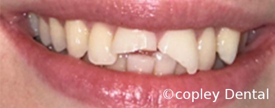 CASE 57: Fractured Tooth - Before