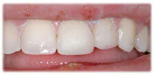 CASE 12: Veneers – Stained Teeth - After