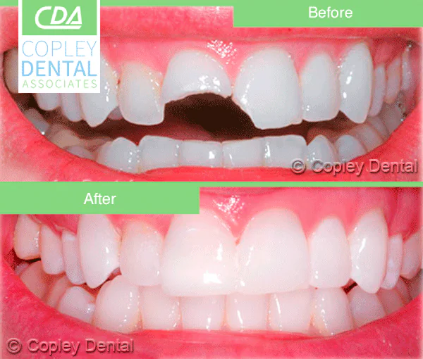 CASE 17: Emergency Treatment – Broken Teeth