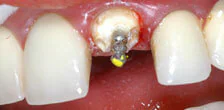 CASE 19: Emergency Treatment – Fractured Tooth - Before