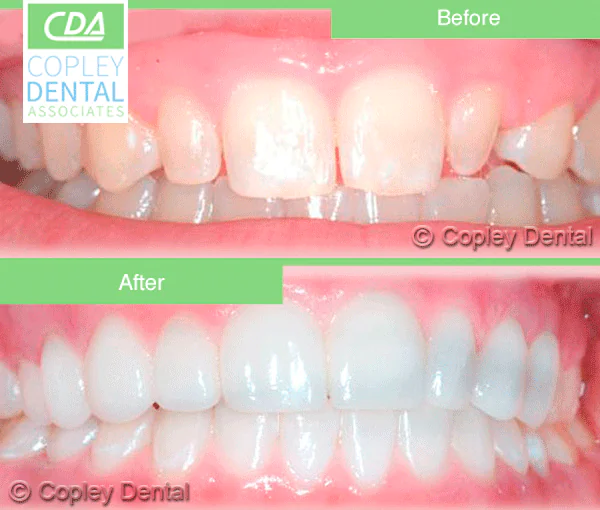 CASE 2: Cosmetic Dentistry – Lumineers
