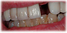 CASE 22: Cosmetic Restoration - Before