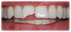 CASE 23: Emergency Treatment – Fractured Tooth - Before