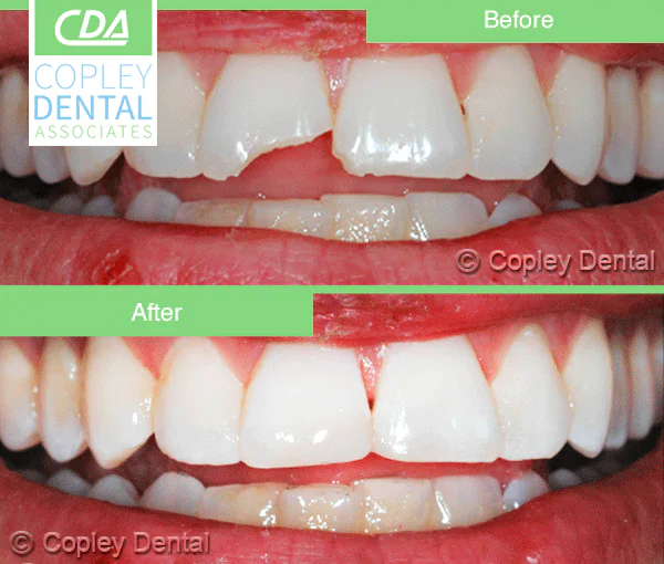 CASE 23: Emergency Treatment – Fractured Tooth