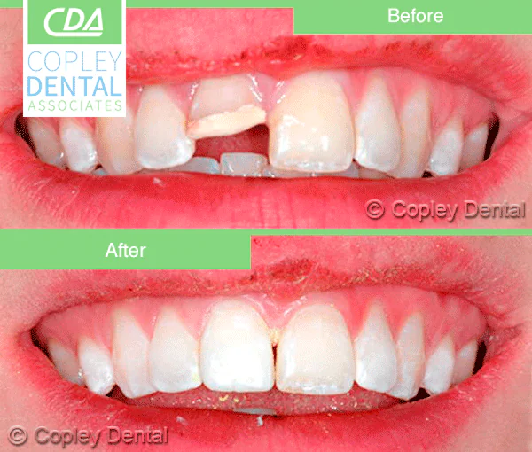 CASE 24: Broken Fractured Tooth