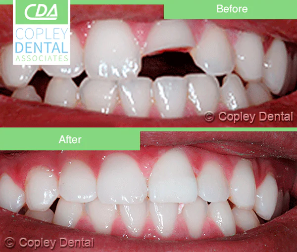 CASE 27: Emergency Treatment – Fractured Tooth