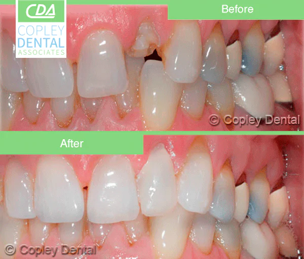 CASE 3: Emergency Dentist Fractured Broken Tooth