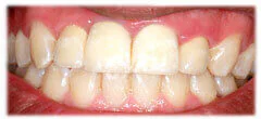 CASE 31: Cosmetic Restoration - After