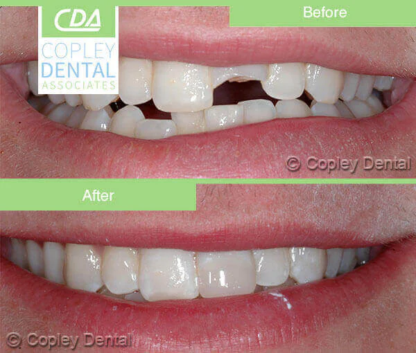 CASE 35: Broken Fractured Tooth