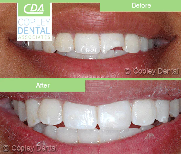 CASE 36: Emergency Treatment – Broken Tooth