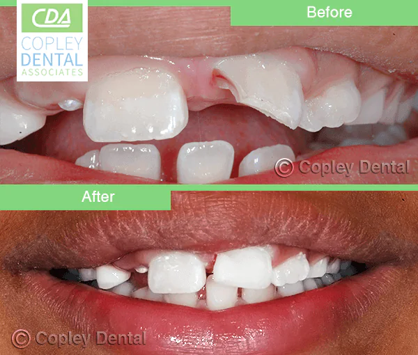 CASE 38: Emergency Treatment – Fractured Tooth