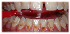 CASE 4: Cosmetic Dentistry–Cleaning–Whitening - Before