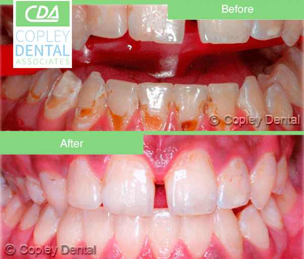 CASE 4: Cosmetic Dentistry–Cleaning–Whitening