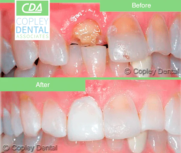 CASE 5: Emergency Dentist Fractured Broken Tooth